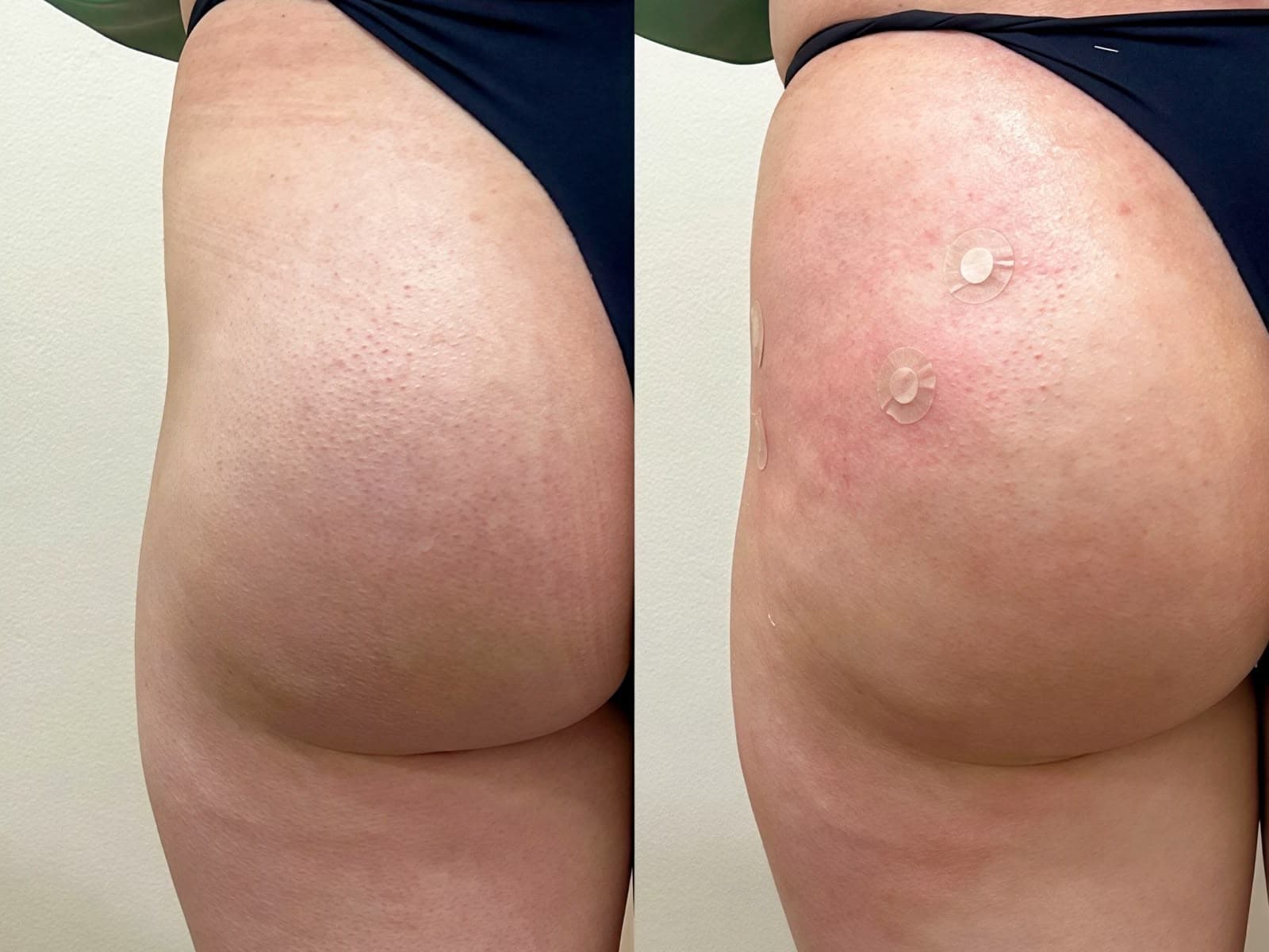 Resultado de harmonização glútea na IGS Clinic